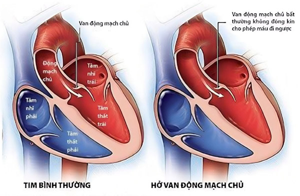 Hở van động mạch chủ thường nặng hơn hở các van tim khác.
